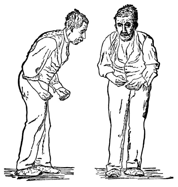 Maladie de Parkinson - Neurolixis